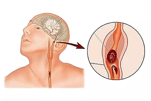 血栓在腦部血管，產生就導致腦梗。