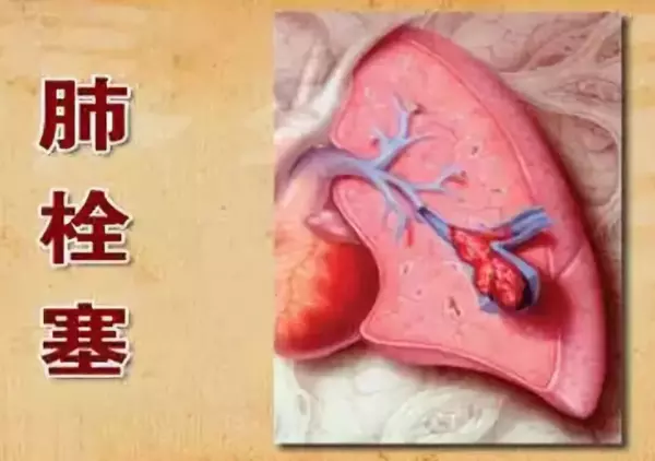 血栓堵塞到肺部，就是「肺栓塞」