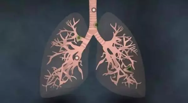 有些人不抽菸也會得肺癌