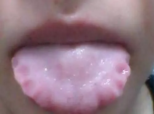 舌頭周圍有明顯的齒痕