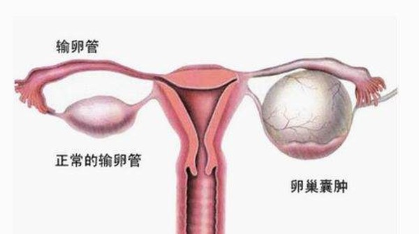 卵巢囊腫
