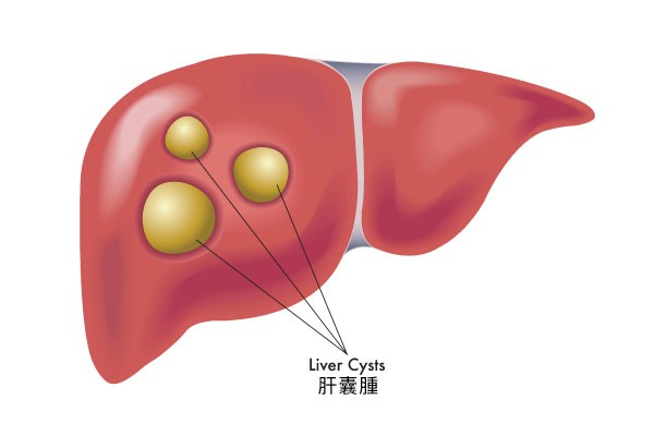 肝囊腫