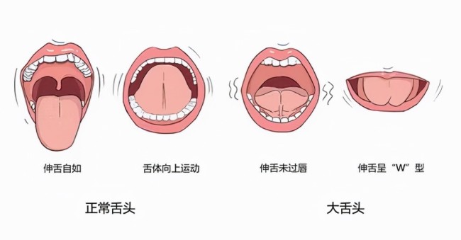 舌頭長短會妨礙說話